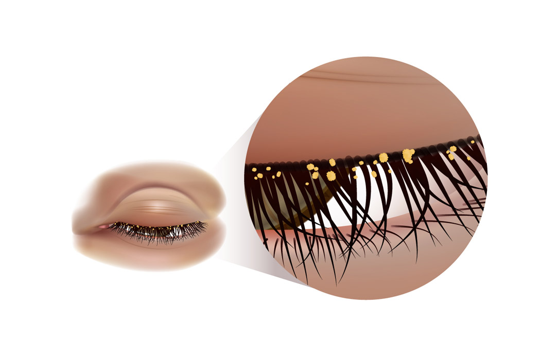 Blepharitis and Meibomian Gland Dysfunction (Sticky and Crusty Eyelids